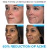 Effaclar Duo Dual Action Acne Treatment de La Roche Posay - Imagen 3